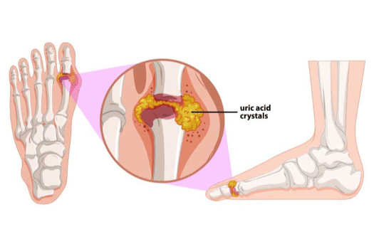 4. Preventing Gout